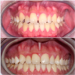 Bạn chọn niềng răng trong 9 tháng, hay làm răng sứ trong 3 ngày