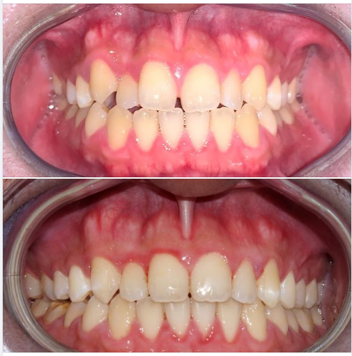 Bạn chọn niềng răng trong 9 tháng, hay làm răng sứ trong 3 ngày