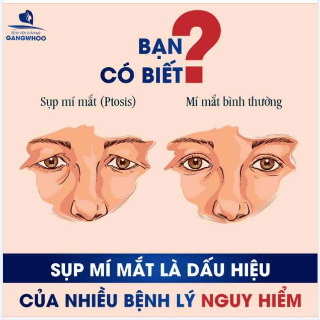 BẠN CÓ BIẾT: SỤP MÍ MẮT LÀ DẤU HIỆU CỦA NHIỀU BỆNH LÝ NGUY HIỂM