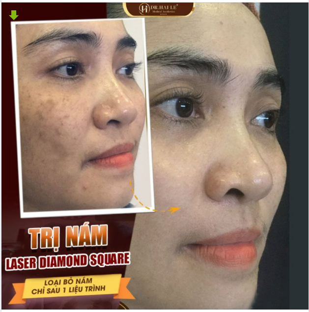 BẠN CÓ BIẾT? TRỊ NÁM PHẢI ĐÚNG PHƯƠNG PHÁP MỚI AN TOÀN VÀ HIỆU QUẢ
