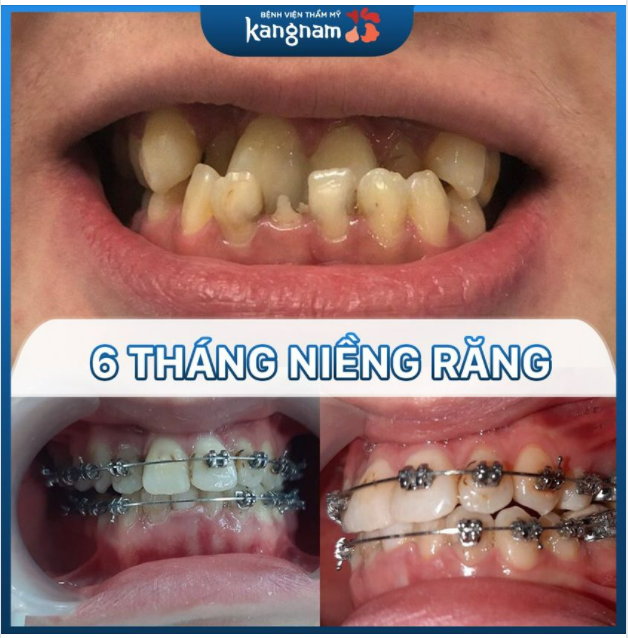 Bạn có tin khách hàng mới chỉ Niềng Răng 6 tháng thôi không ạ?