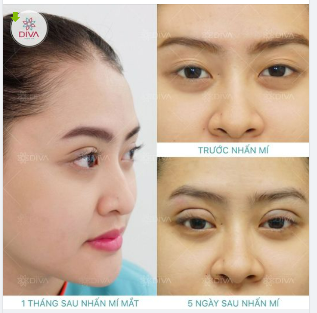 BẠN HIỂU GÌ VỀ PHƯƠNG PHÁP NHẤN MÍ MẮT ?