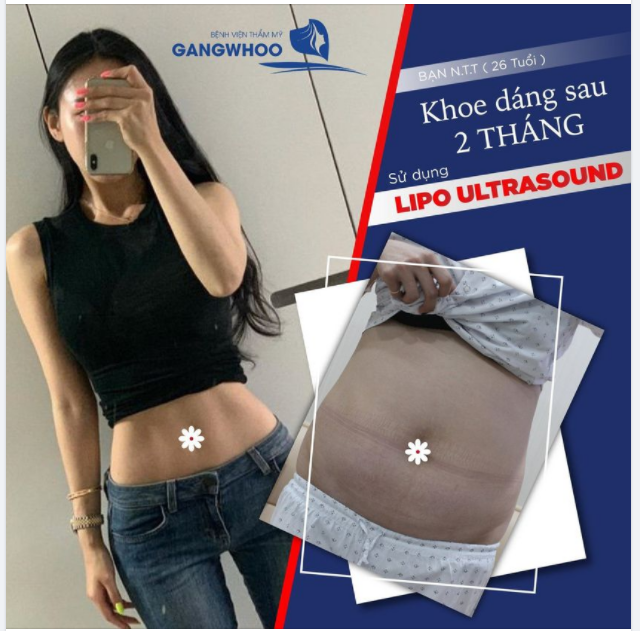 BẠN N.T. T (26 TUỔI) KHOE DÁNG SAU 2 THÁNG SỬ DỤNG HÚT MỠ CÔNG NGHỆ CAO LIPO ULTRASOUND