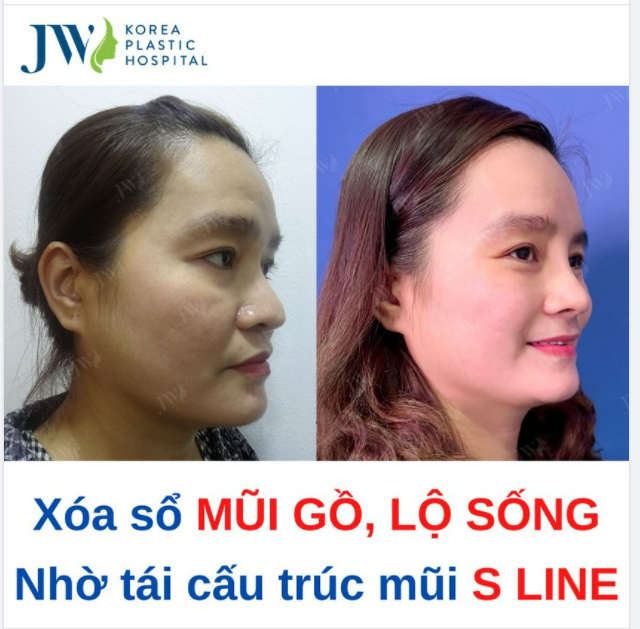 Bạn nâng mũi lâu năm, dáng mũi không còn hợp thời?