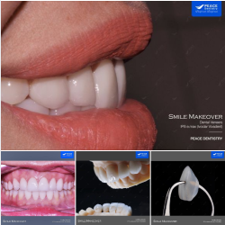 BẢO TỒN RĂNG TỰ NHIÊN TỐI ƯU