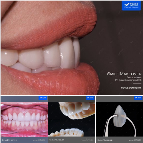 BẢO TỒN RĂNG TỰ NHIÊN TỐI ƯU