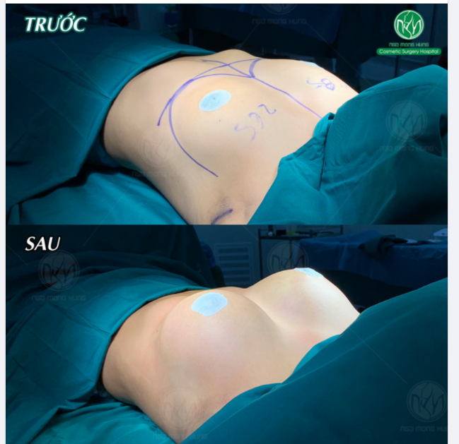 BẦU NGỰC NHỎ "HÓA" CĂNG TRÒN - ĐẸP HOÀN HẢO SAU PT