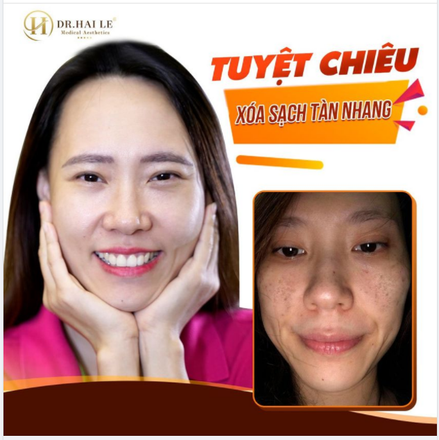 Bấy lâu nay người ta vẫn đồn: Hễ bị tàn nhang đến Dr.Hải Lê kiểu gì cũng khỏi, lại nhẹ nhàng vô cùng, điều khiến người ta mê mẩn nhất đó là hiệu quả duy trì cực kì dài lâu.