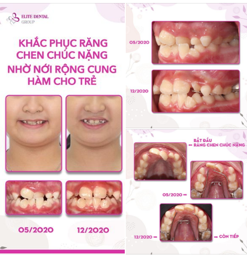  BÉ 8 TUỔI RĂNG LỆCH LẠC CHEN CHÚC NẶNG