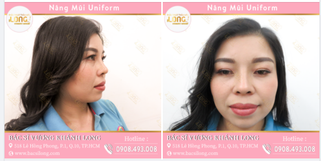 BÍ QUYẾT CHĂM SÓC MŨI SAU NÂNG TẠI NHÀ TRONG MÙA DỊCH