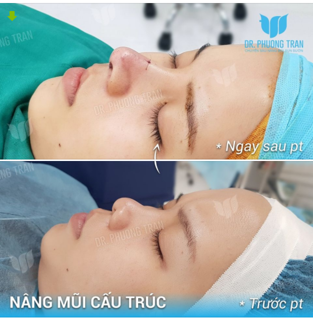 BÍ QUYẾT XINH ĐẸP LÀ NÂNG MŨI CẤU TRÚC