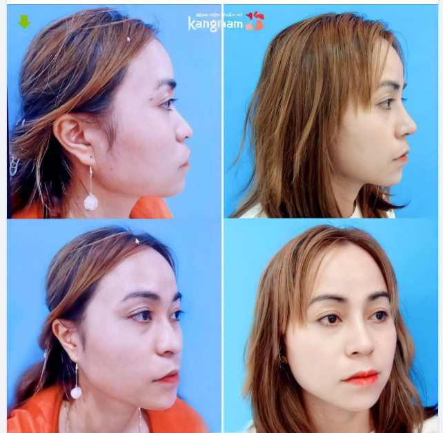 Biến đổi hoàn toàn sau NÂNG MŨI CẤU TRÚC 4D kết hợp chỉnh xương