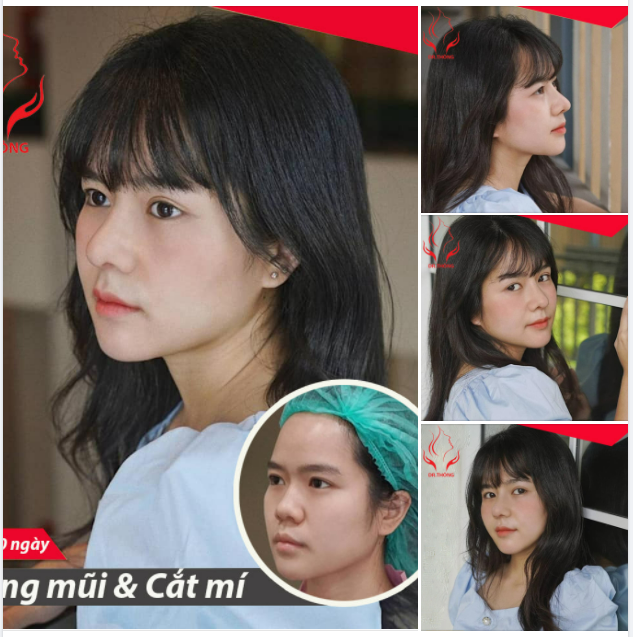 "BIẾT ĐẸP NHƯ VẦY, EM SẼ LÀM SỚM HƠN!!!" ĐẸP NHƯ MỘT "NÀNG THƠ" SAU NÂNG MŨI CẮT MÍ