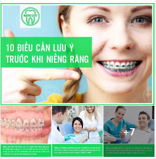 Bỏ túi 10 điều cần lưu ý trước khi niềng răng để sau dịch mình đi niêng răng bạn nhé!
