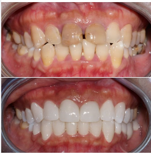Bọc răng sứ và dán Veneer sứ có thể làm được cùng với nhau không