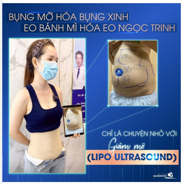 BỤNG MỠ HOÁ BỤNG XINH - EO BÁNH MÌ HOÁ EO NGỌC TRINH CHỈ LÀ CHUYỆN NHỎ VỚI HÚT MỠ LIPO ULTRASOUND