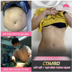 BỤNG PHẲNG LÌ - EO THON GỌN CHỈ SAU 14 NGÀY HÚT MỠ TẠO HÌNH