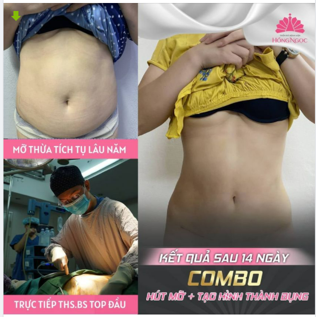 BỤNG PHẲNG LÌ - EO THON GỌN CHỈ SAU 14 NGÀY HÚT MỠ TẠO HÌNH