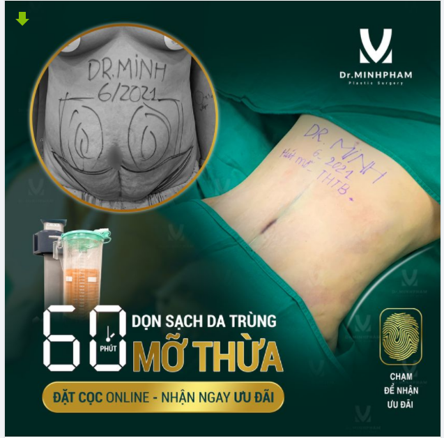 BỤNG SỒ SỀ - CÓ VỀ ĐƯỢC EO THON? COMBO HÚT MỠ + TẠO HÌNH THÀNH BỤNG chính là câu trả lời.