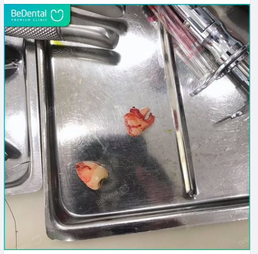 Buổi sáng cuối tuần nhẹ nhàng tại Bedental với ca xử lý 2 chiếc răng khôn mọc dại