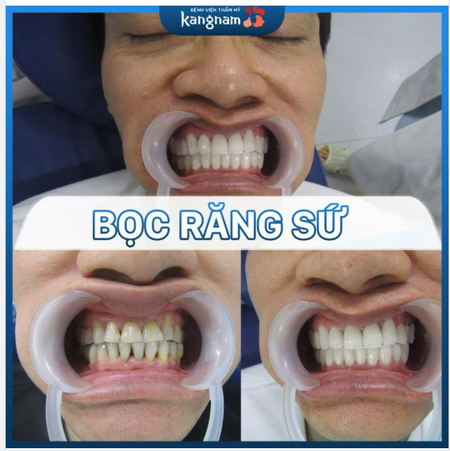 Ca bọc răng sứ thứ 50 của tháng 6 này rồi ạ!