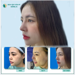 Ca "giải cứu" mũi HỎNG cực xuất sắc của bác sĩ Đông Á