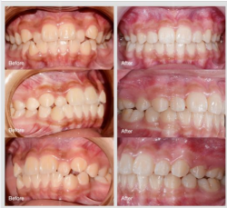 Ca lâm sàng -  niềng răng chỉnh hô, tháo mắc cài sau hơn 18 tháng