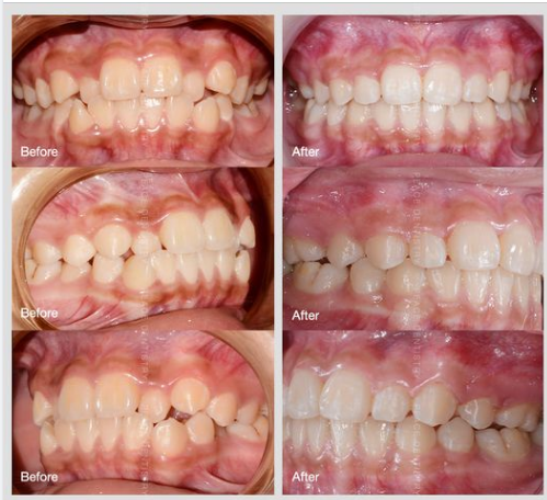 Ca lâm sàng -  niềng răng chỉnh hô, tháo mắc cài sau hơn 18 tháng