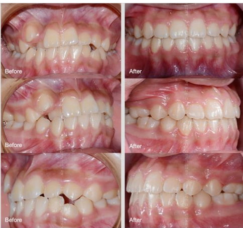 Ca lâm sàng: chỉnh nha mắc cài hoàn thành sau 20 tháng  (Khách hàng nữ: 14 tuổi)