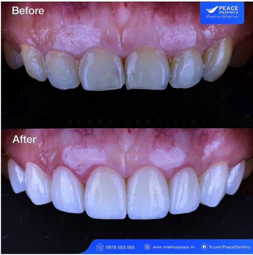 Ca lâm sàng: điều chỉnh hình thể và màu răng bằng mặt sứ Veneer, mài răng tối thiểu