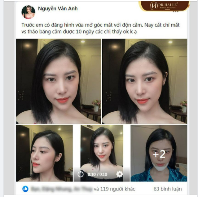 Cả nhà cho cô nàng xin ý kiến về kết quả Độn Cằm V-line 10 ngày và mở góc mắt nào?