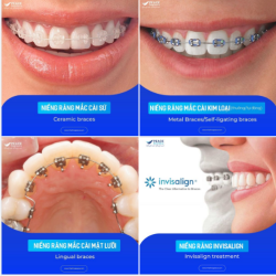 CÁC LOẠI MẮC CÀI NIỀNG RĂNG & CHỈNH NHA INVISALIGN TẠI PEACE DENTISTRY