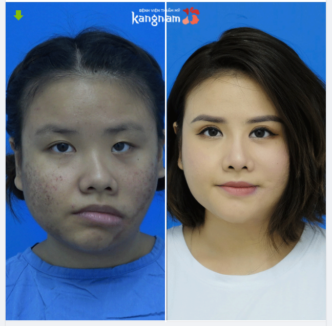 Cằm lệch - mũi vẹo, tẹt - Mí mắt lệch LỘT XÁC xuất thần sau thẩm mỹ