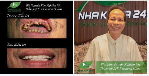 BỌC RĂNG SỨ CHO RĂNG SÂU CÓ TỐT KHÔNG