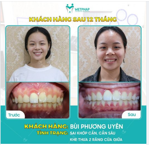 CASE 1035: KHẮC PHỤC TÌNH TRẠNG THƯA RĂNG CỬA, SAI KHỚP CẮN