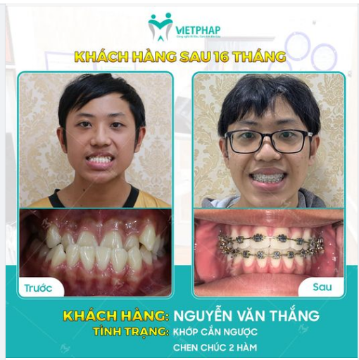 CASE 1036: GIẢI CỨU RĂNG MỌC CHEN CHÚC, KHỚP CẮN NGƯỢC