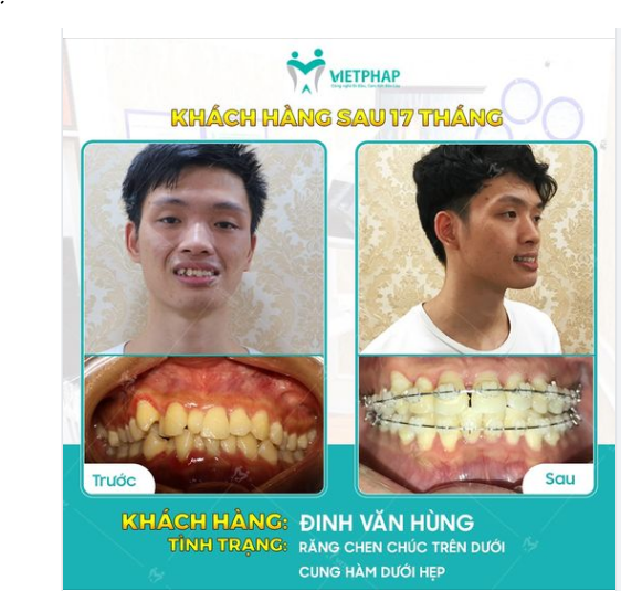 CASE 1037: KHẮC PHỤC RĂNG MỌC CHEN CHÚC/ KHẤP KHỂNH/ 6930