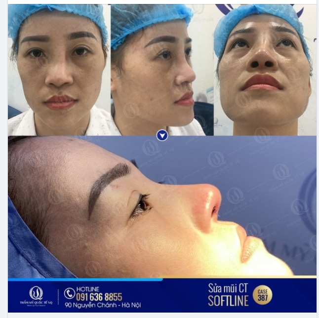 CASE 387 KẾT QUẢ Sửa mũi lệch sống