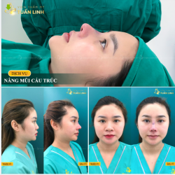 Case Nâng mũi cấu trúc với DÁNG MŨI BAY nhưng vẫn đảm bảo yếu tố tự nhiên, mềm mại cho khuôn mặt khách.