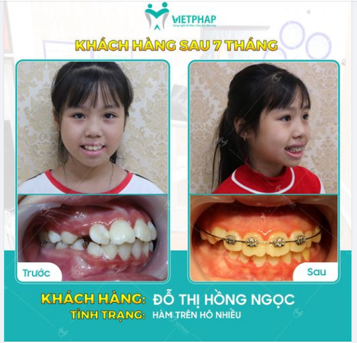 Case niềng răng số 1038: Khắc phục tình trạng răng hô cho bé Đỗ Thị Hồng Ngọc