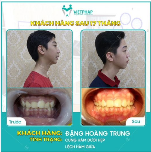 Case niềng răng số 1039: Sở hữu góc nghiêng "thần thánh" nhờ chỉnh nha mắc cài kim loại