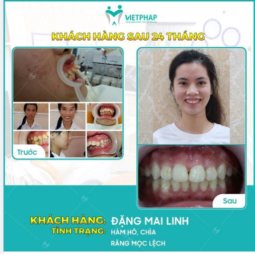 Case niềng răng số 1040: Giải cứu răng hô, chìa, khấp khểnh cho KH Đặng Mai Linh