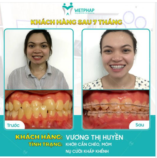 Case niềng răng số 1041: Sai lệch khớp cắn nặng - Xử lý như thế nào