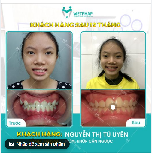 Case niềng răng số 1042: Khắc phục tình trạng khớp cắn ngược cho KH Tú Uyên