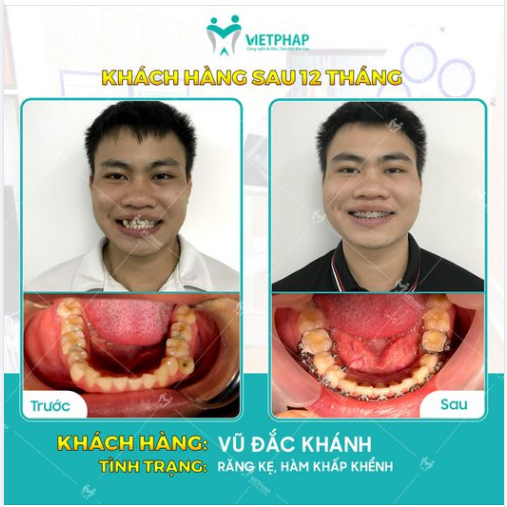 Case niềng răng số 1042: Răng khấp khểnh, lệch lạc - Đều đẹp chỉ sau 12 tháng