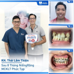 Case Niềng Răng Số 406 - 8 Tháng Thay Đổi Bất Ngờ