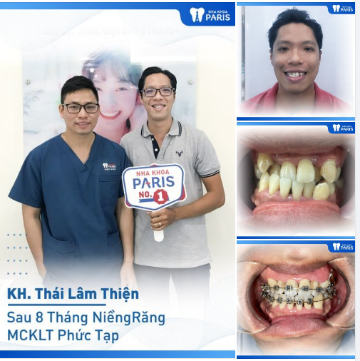 Case Niềng Răng Số 406 - 8 Tháng Thay Đổi Bất Ngờ