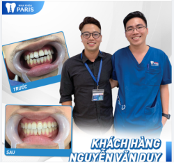 Case Niềng Răng Số 407 - Khắc Phục Khớp Cắn Hở Chỉ Sau 12 Tháng