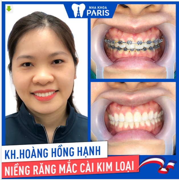 Case Niềng Răng Số 413 - Nụ Cười Đẹp Chỉ Sau 16 Tháng