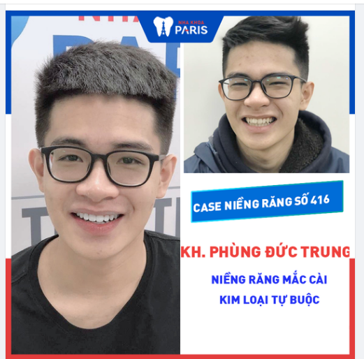 Case Niềng Răng Số 416 - Lột Xác Nụ Cười Cho Hot Boy Đeo Kính